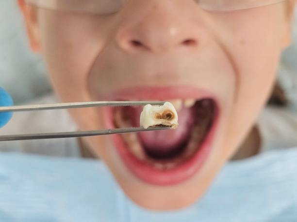Best Emergency Dental Extractions in Koontz Lake, IN